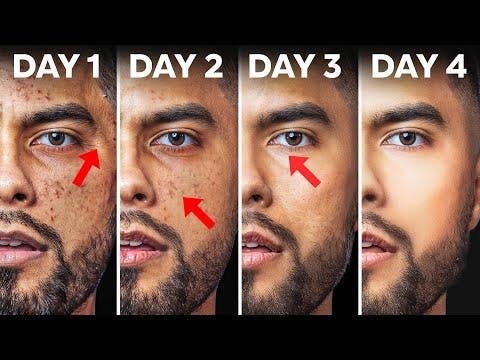 How To Fix Your Skin in 4 Days  (Use At Home Products)